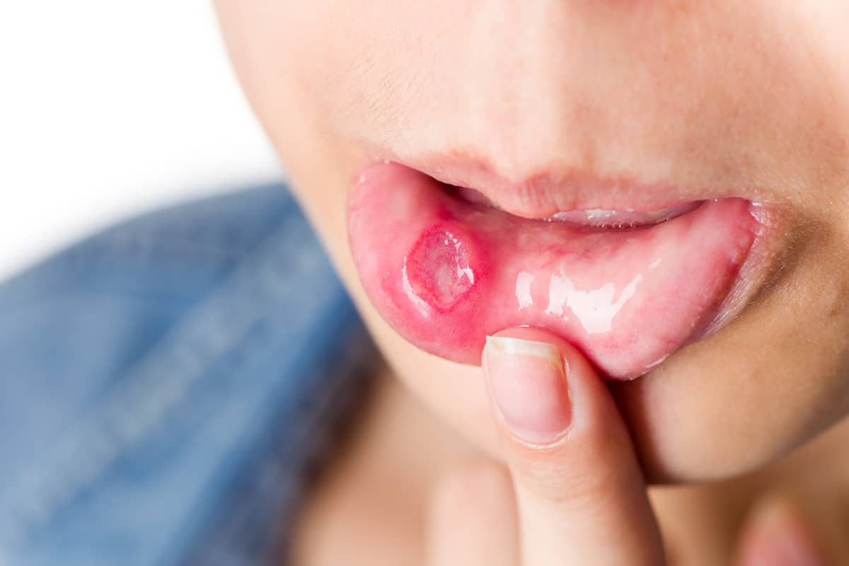 Llagas en la boca: 3 remedios que funcionan