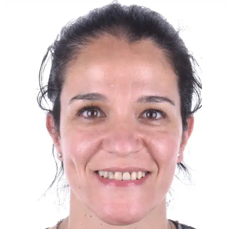 caso real carillas dentales antes